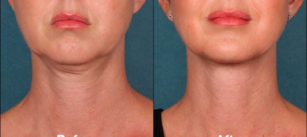 woman's face before ad after Kybella front view