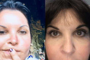 sabel before&after eyelid surgery