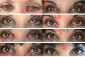 sabel eyelid surgery progress pics
