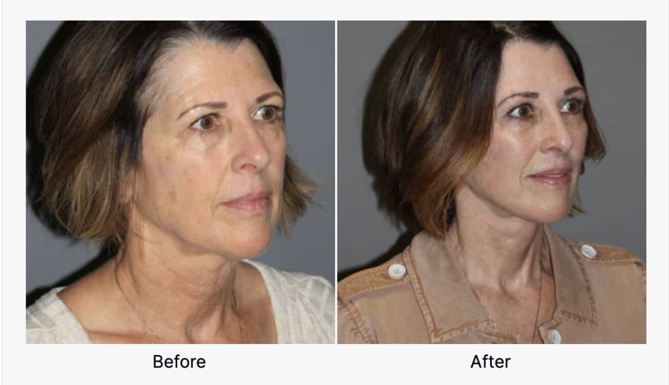 Before And After - Facelift Surgery