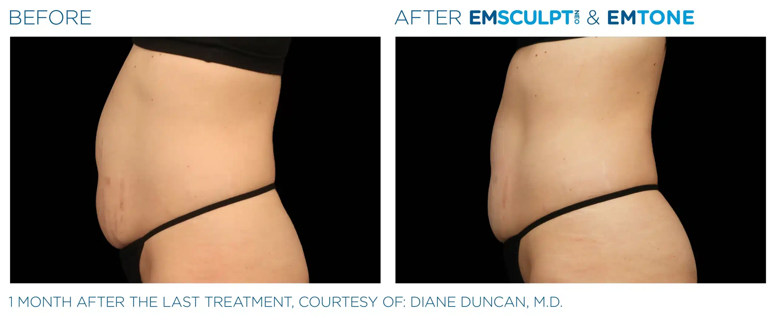 EMSCULPT NEO before and after 004