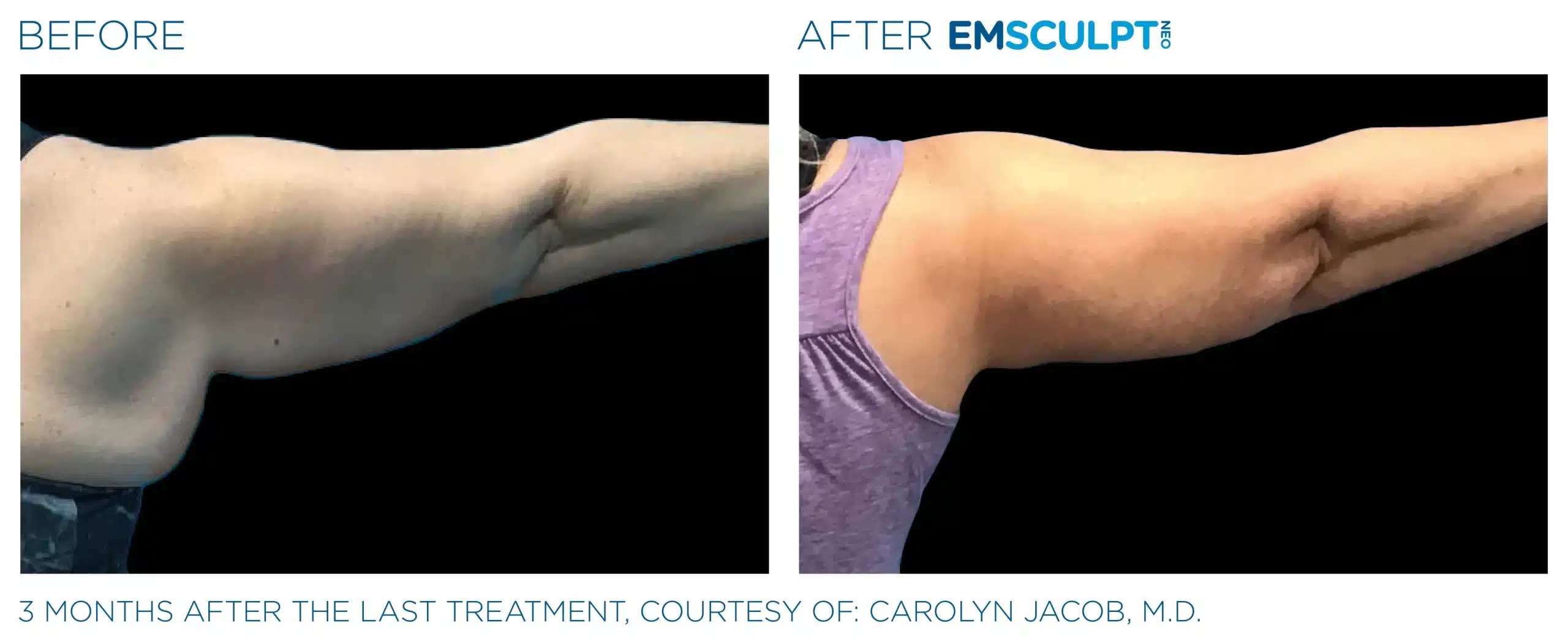 EMSCULPT NEO before and after 78