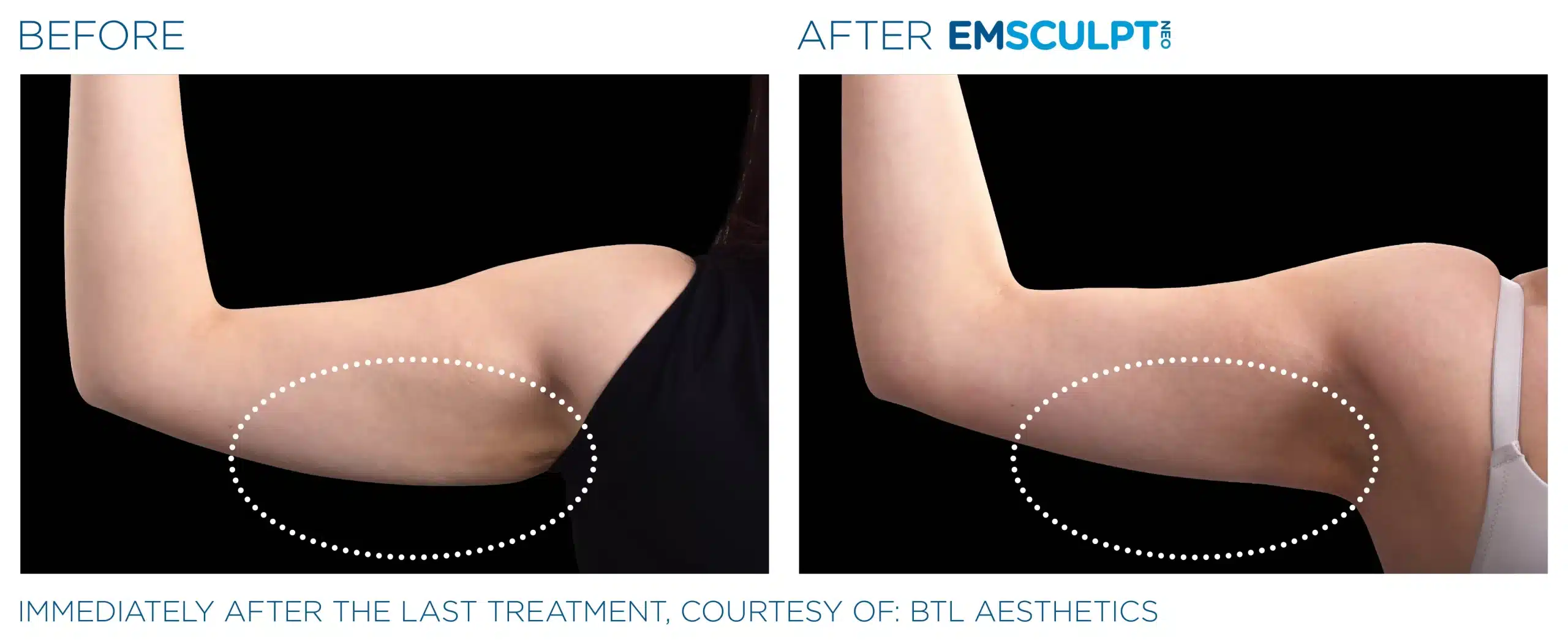 EMSCULPT NEO before and after 100