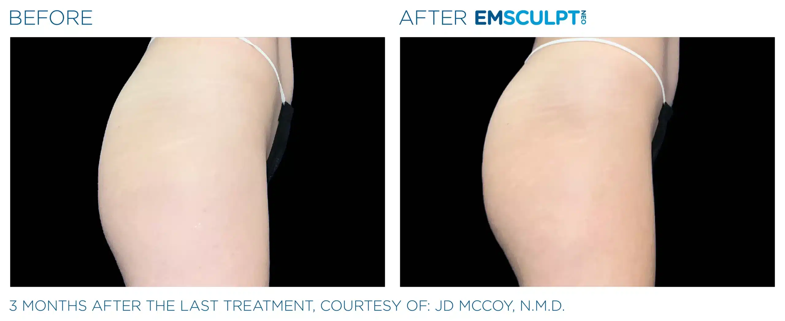 EMSCULPT NEO before and after 74