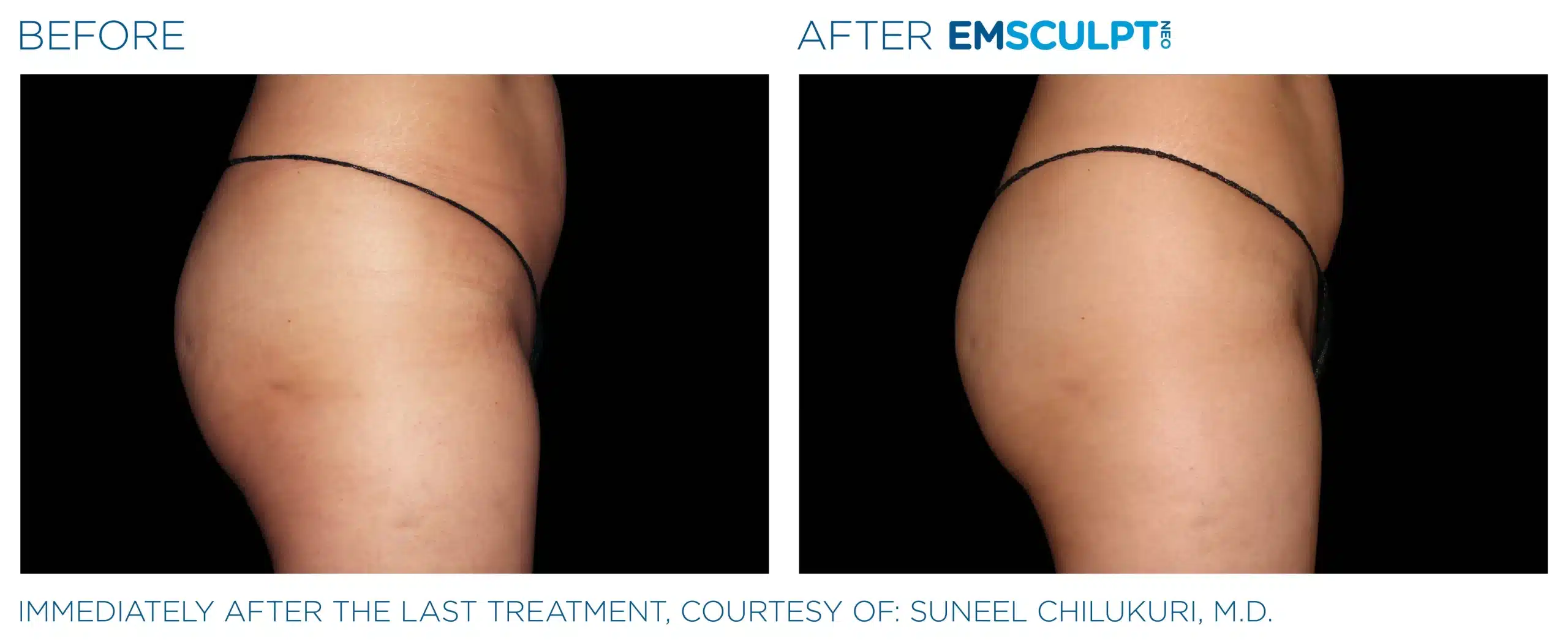 EMSCULPT NEO before and after 76