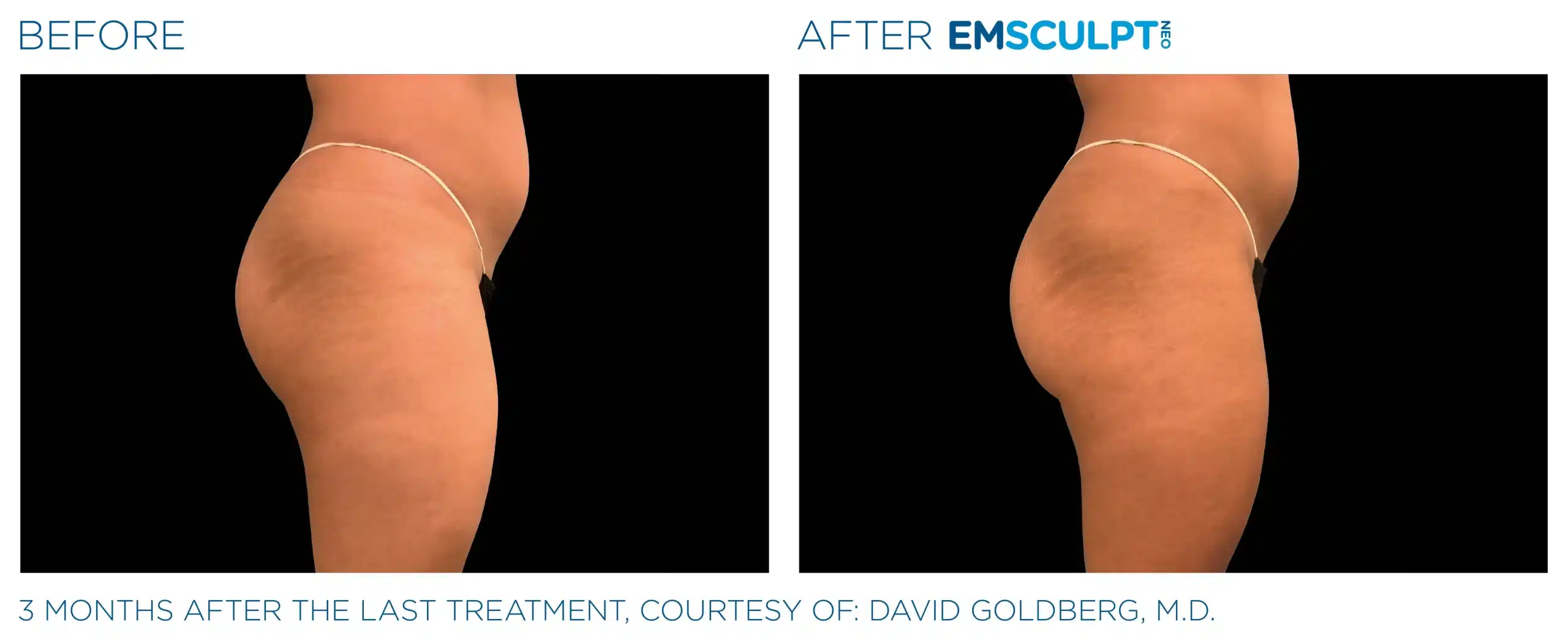 EMSCULPT NEO before and after 98