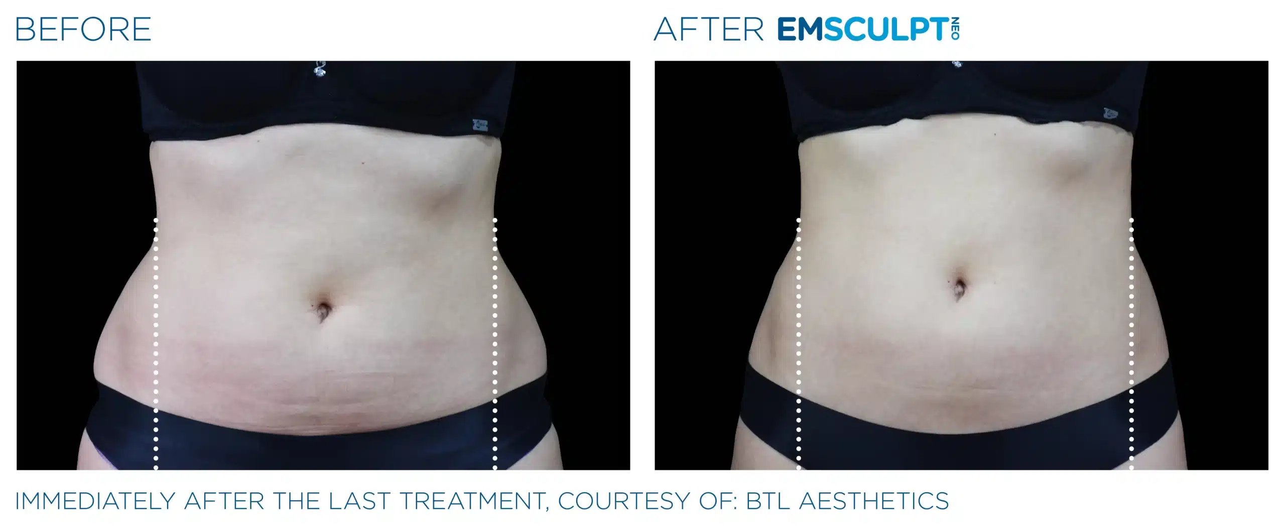 EMSCULPT NEO before and after 102