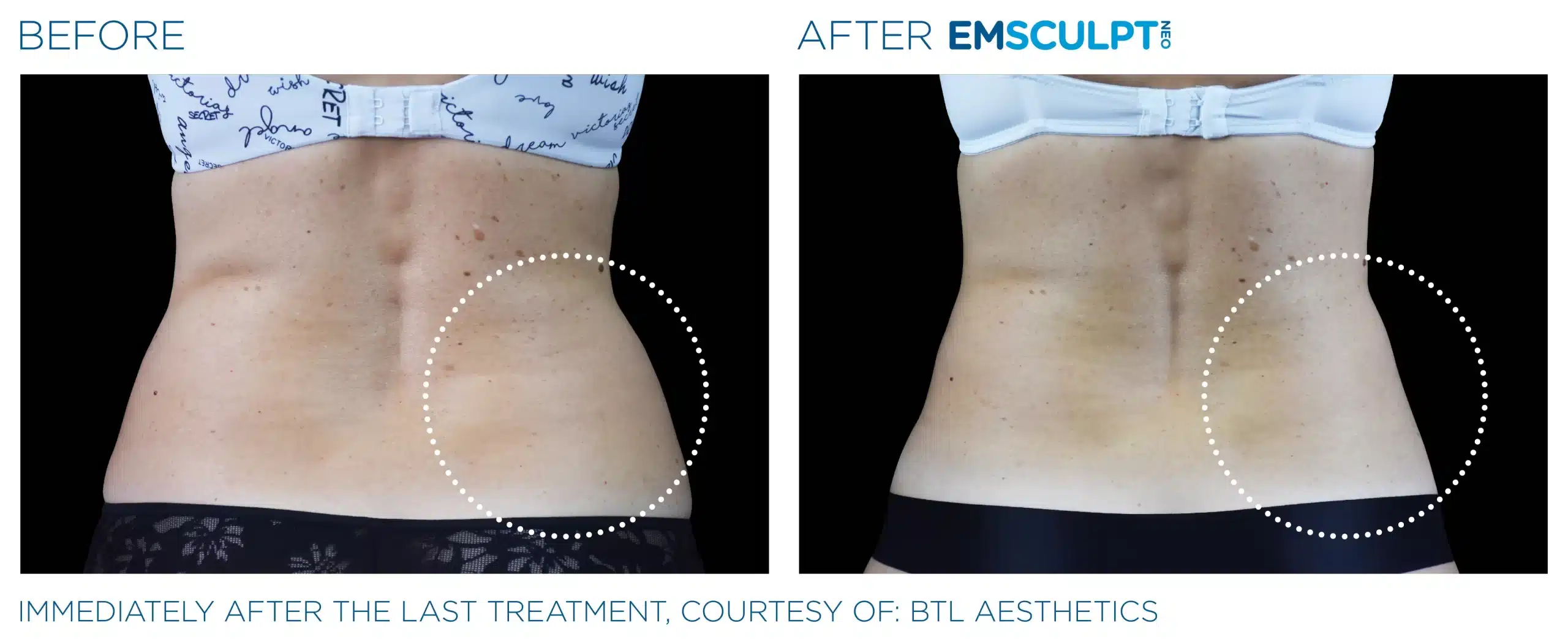 EMSCULPT NEO before and after 103