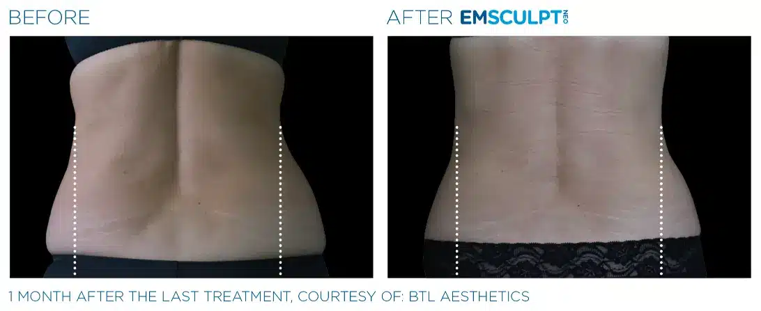 EMSCULPT NEO before and after 117