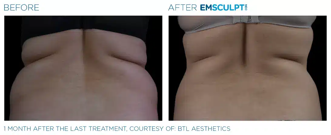 EMSCULPT NEO before and after 118