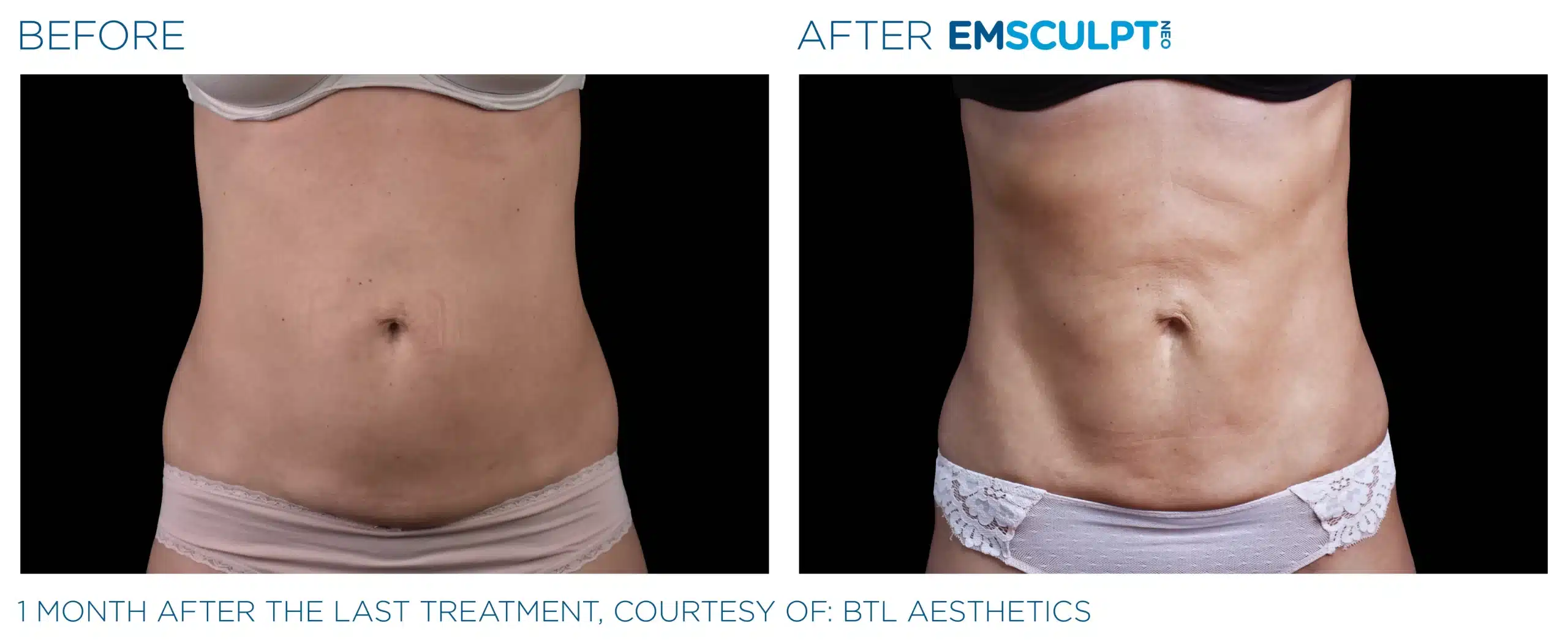 EMSCULPT NEO before and after 120