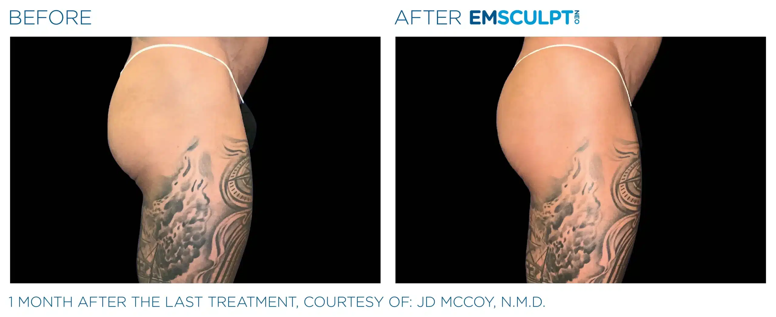 EMSCULPT NEO before and after 088