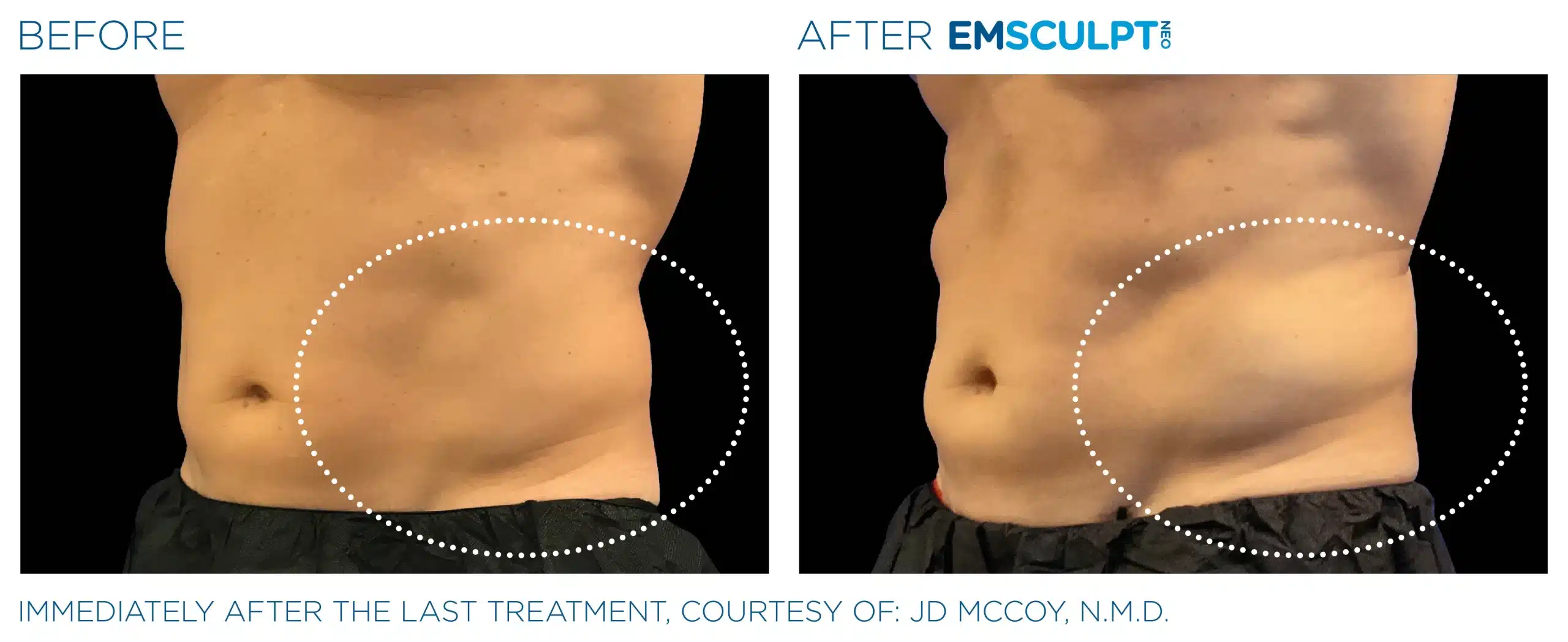 EMSCULPT NEO before and after 121