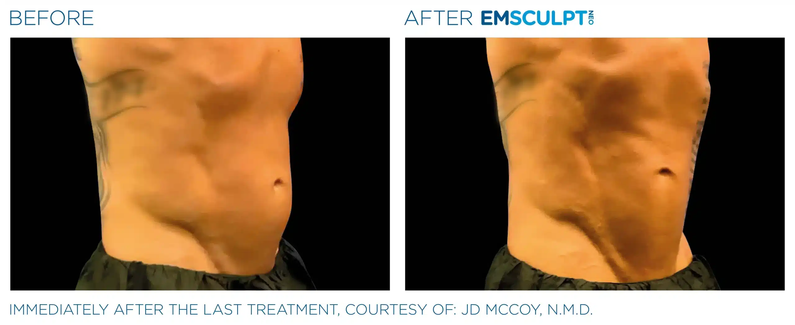 EMSCULPT NEO before and after 123