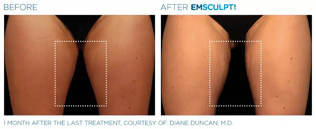 EMSCULPT NEO before and after 66