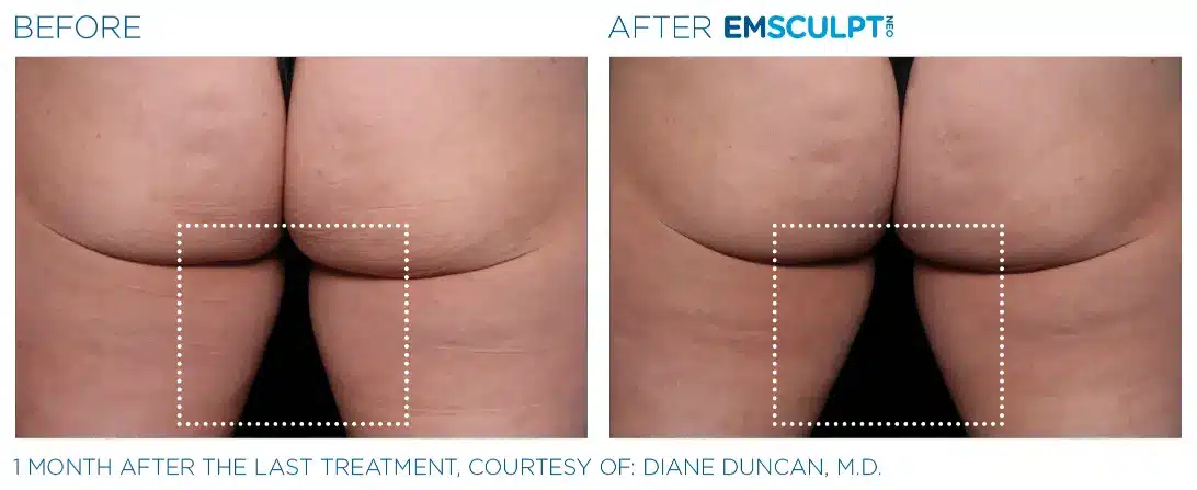 EMSCULPT NEO before and after 68