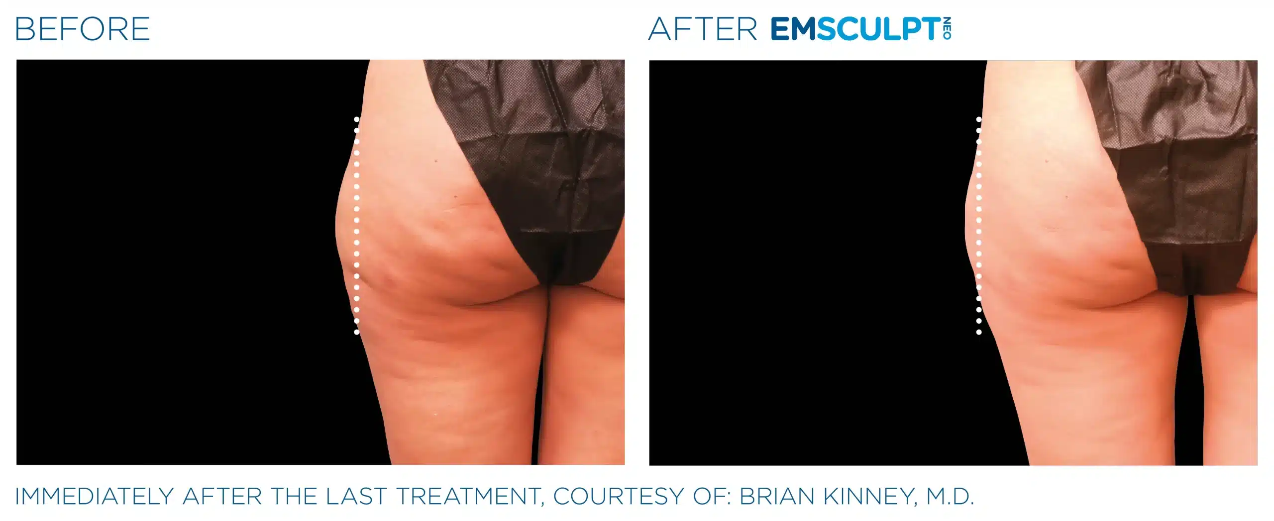 EMSCULPT NEO before and after 92