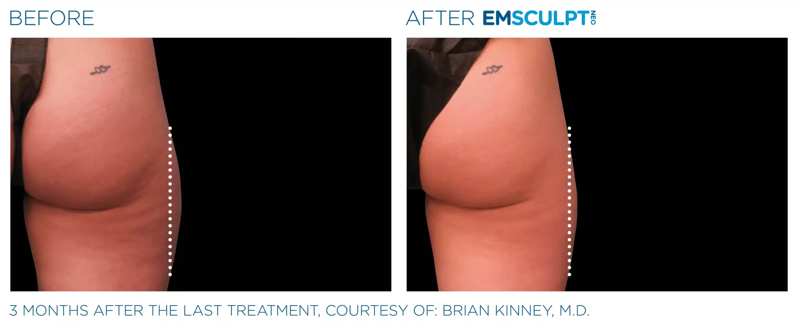 EMSCULPT NEO before and after 93