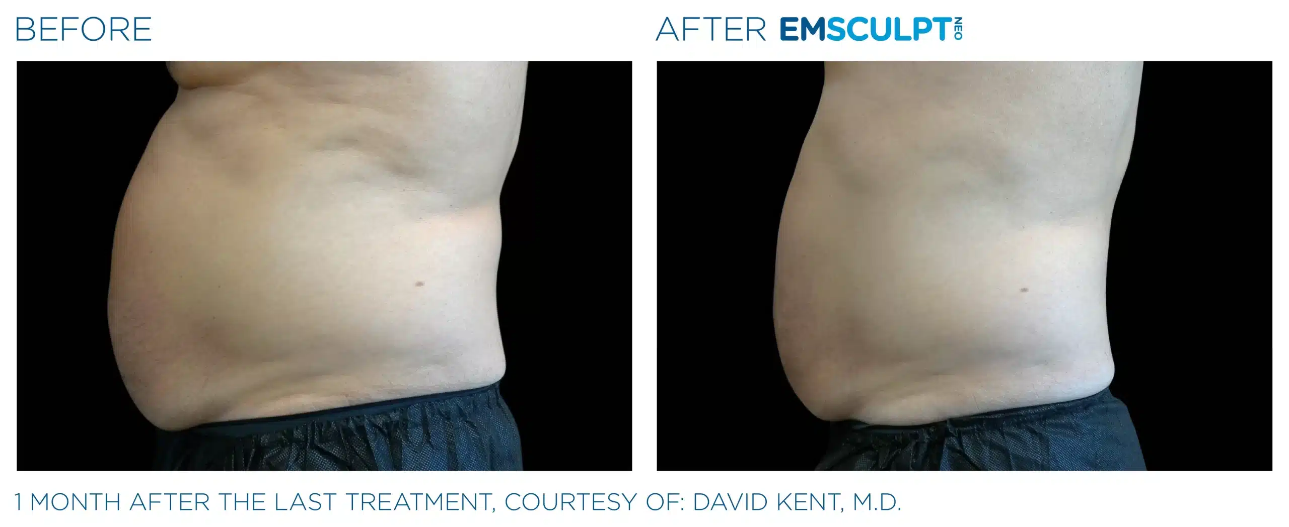 EMSCULPT NEO before and after 002