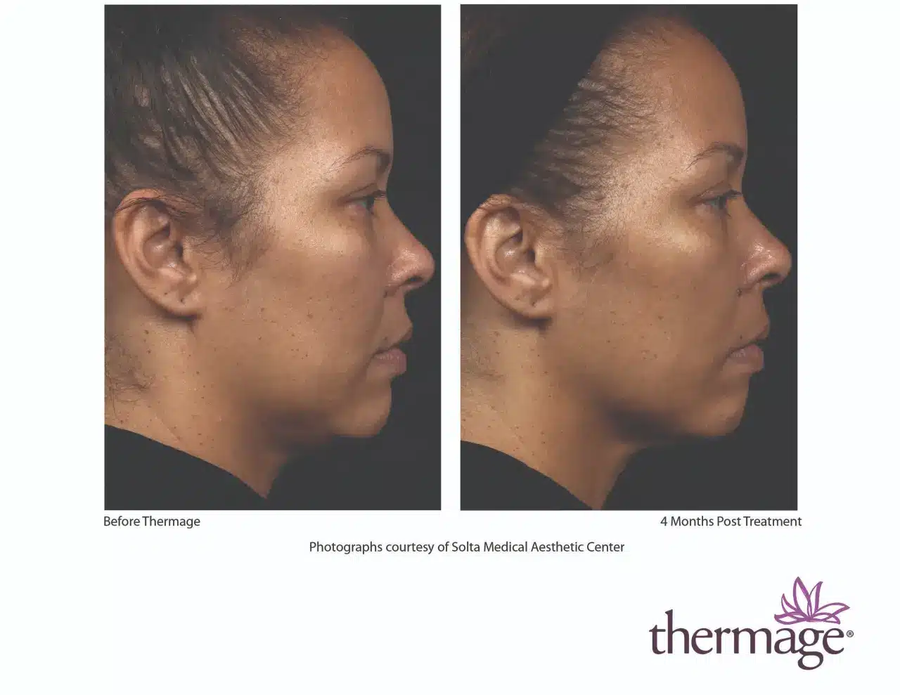 Thermage Before and After 04