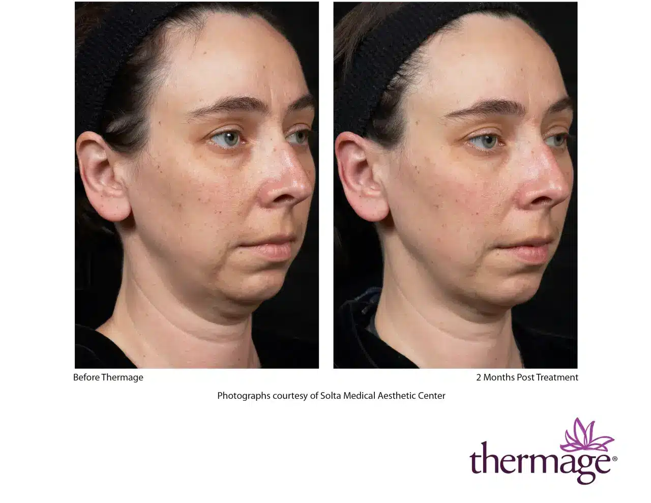 Thermage Before and After 11