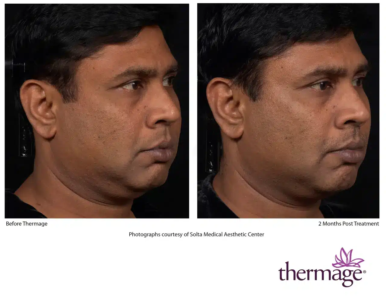 Thermage Before and After 12