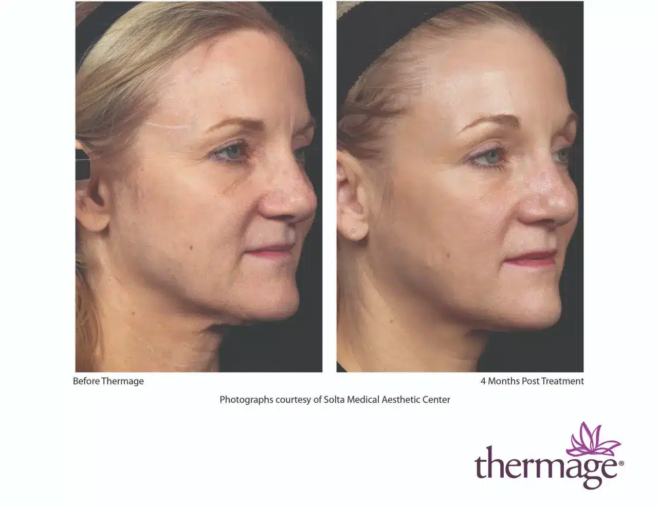 Thermage Before and After 13