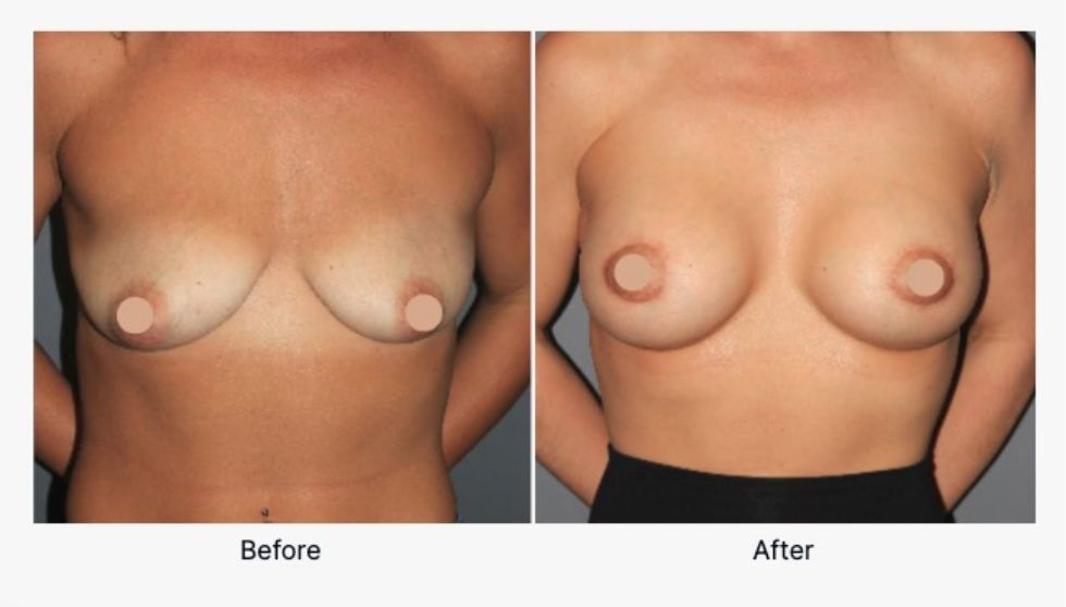 Before and After Breast Augmentation 4