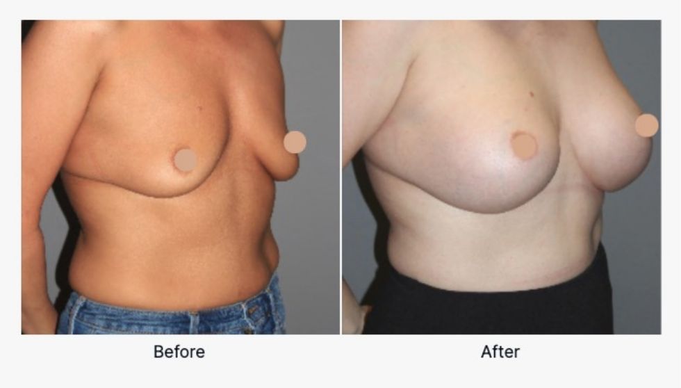 Before and After Breast Augmentation 3