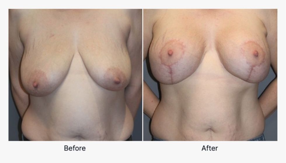 Breast Lift Before and After 1