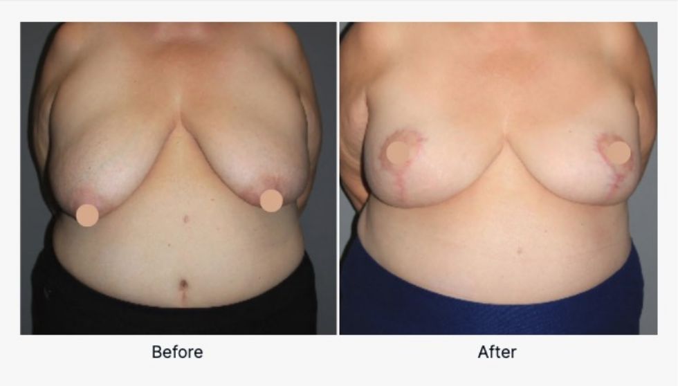 Breast Lift Before and After 3