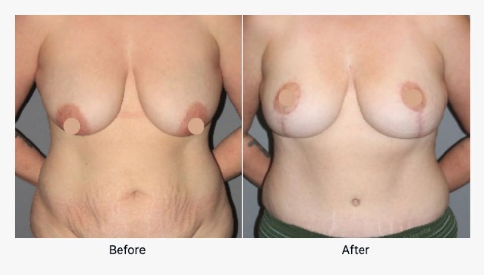 Breast Lift Before and After 2