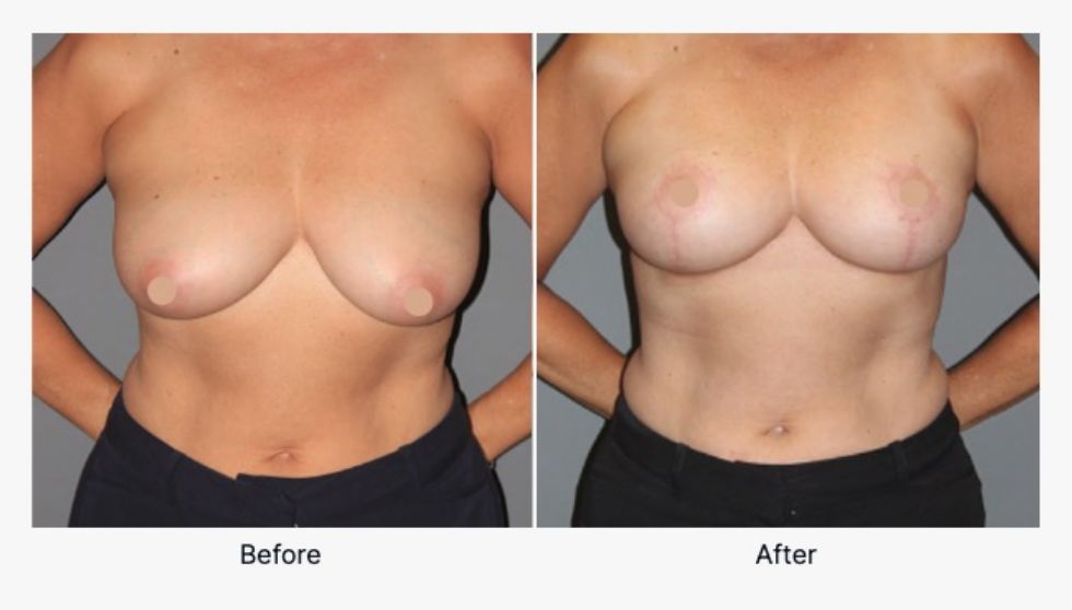 Breast Lift Before and After 4