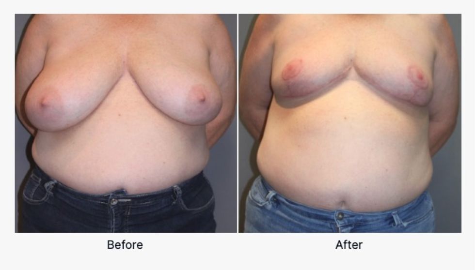 Before and After Breast Reduction 4