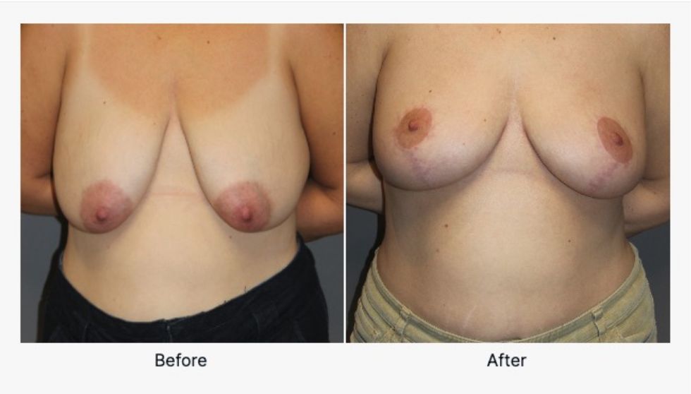 Before and After Breast Reduction 2