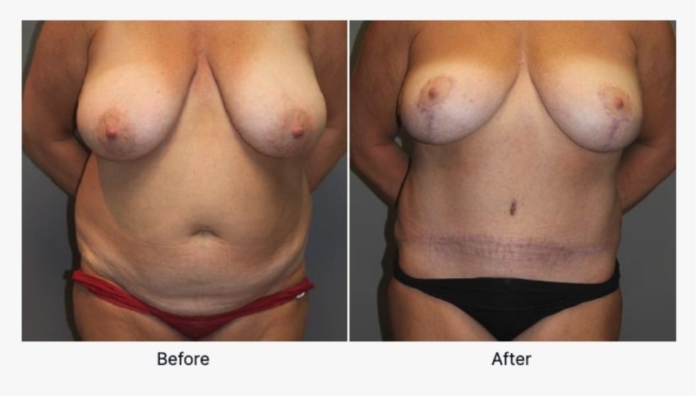 Before and After Breast Reduction 3