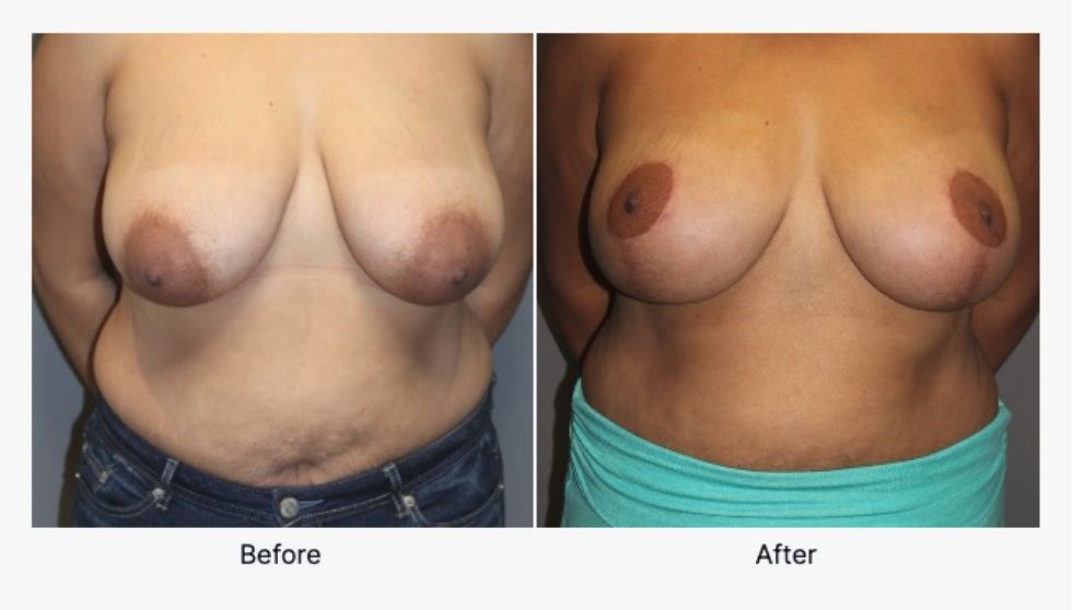 Before and After Breast Reduction 1