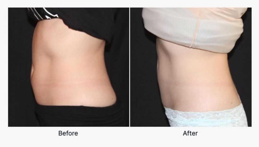 Before and After CoolSculpting®