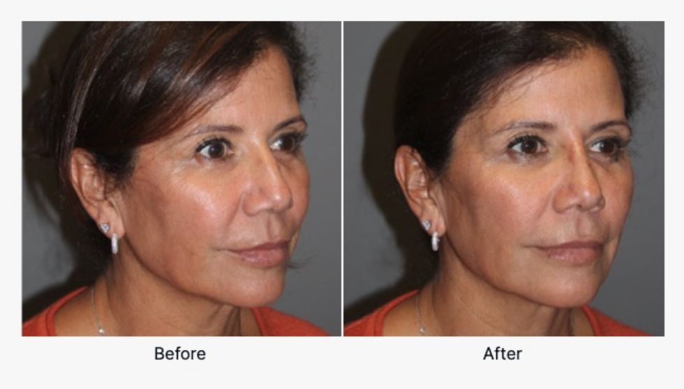 Injectables Before and After 2