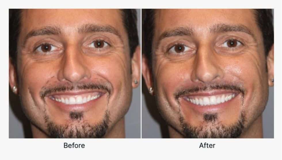 Injectables Before and After 3