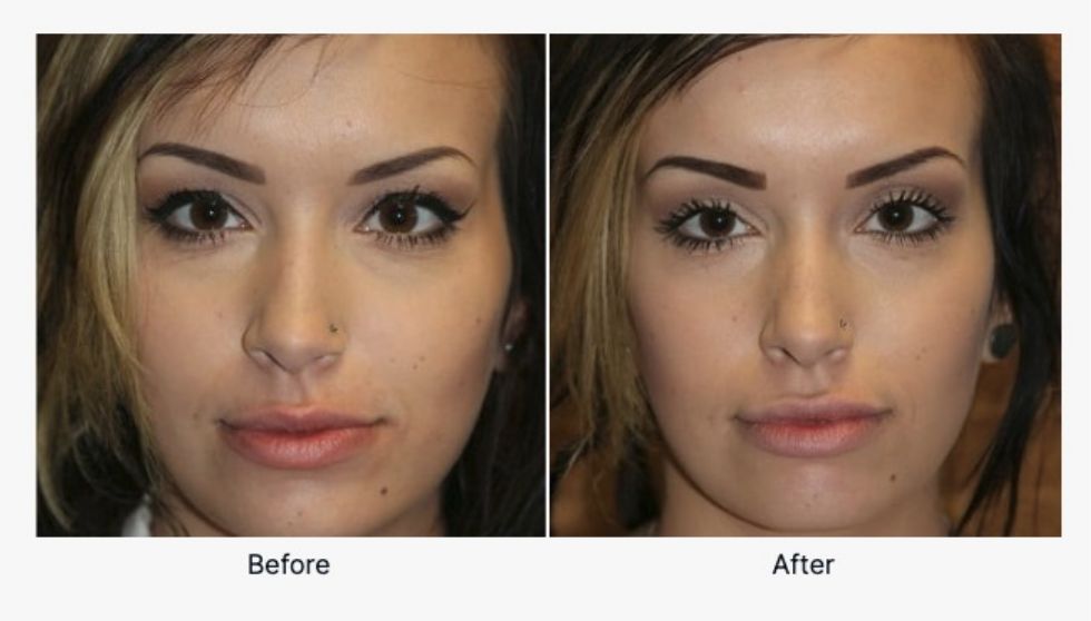 Injectables Before and After 4