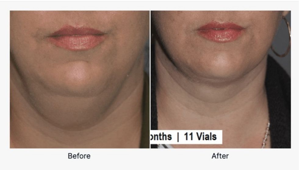 Before And After Kybella 1