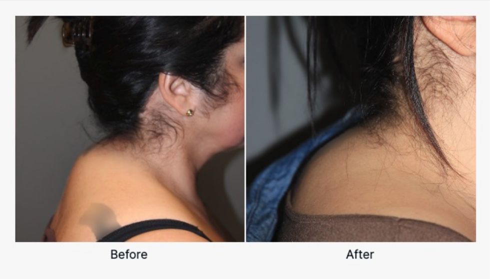 Before And After Kybella 2