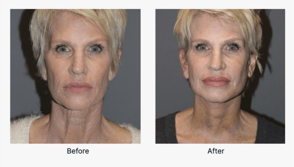 Before and After Neck Lift