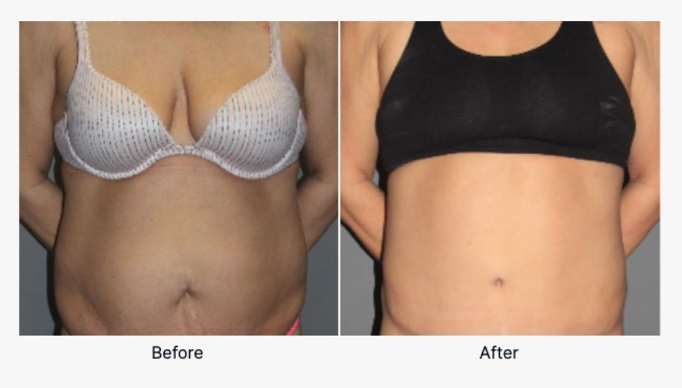 Before and After Tummy Tuck 1