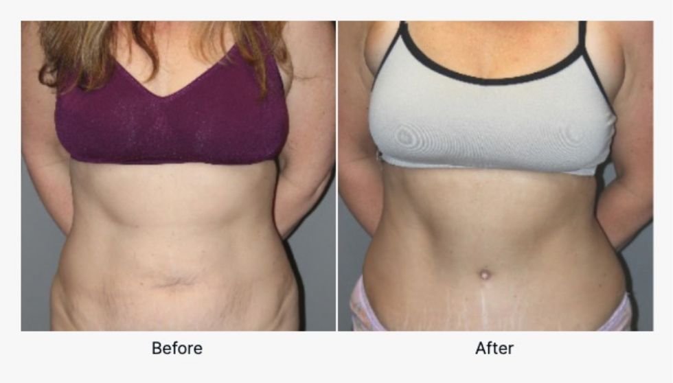 Before and After Tummy Tuck 2