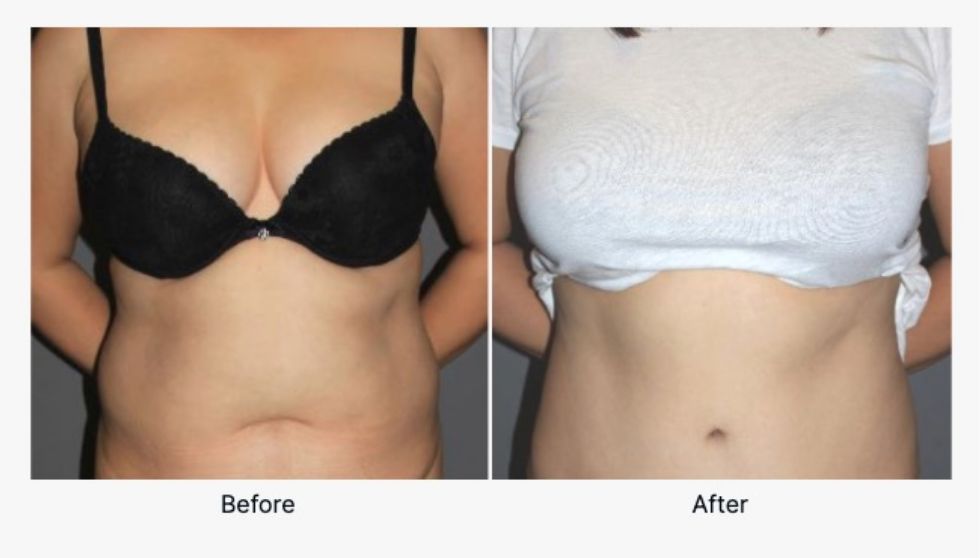 Before and After Tummy Tuck 3