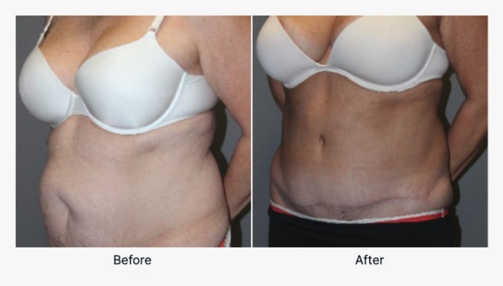 Before and After Tummy Tuck 4