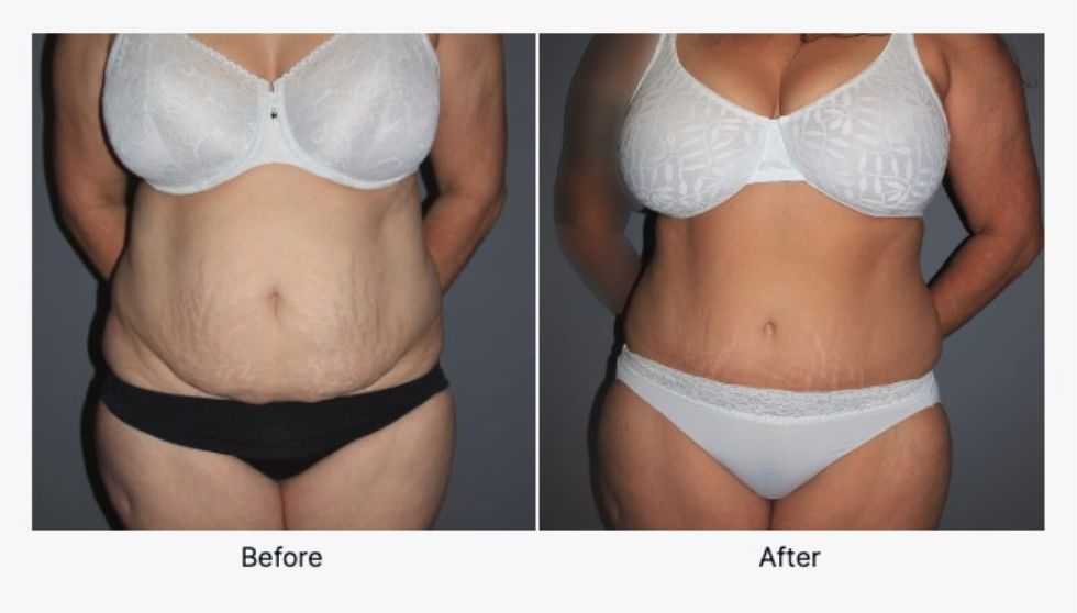 Before and After Tummy Tuck 5