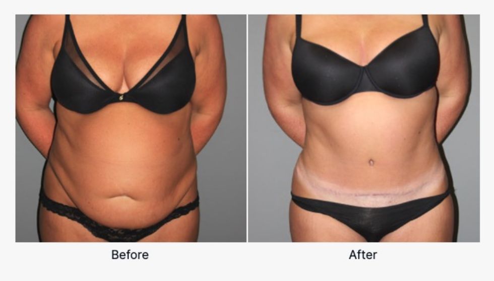 Before and After Tummy Tuck 6